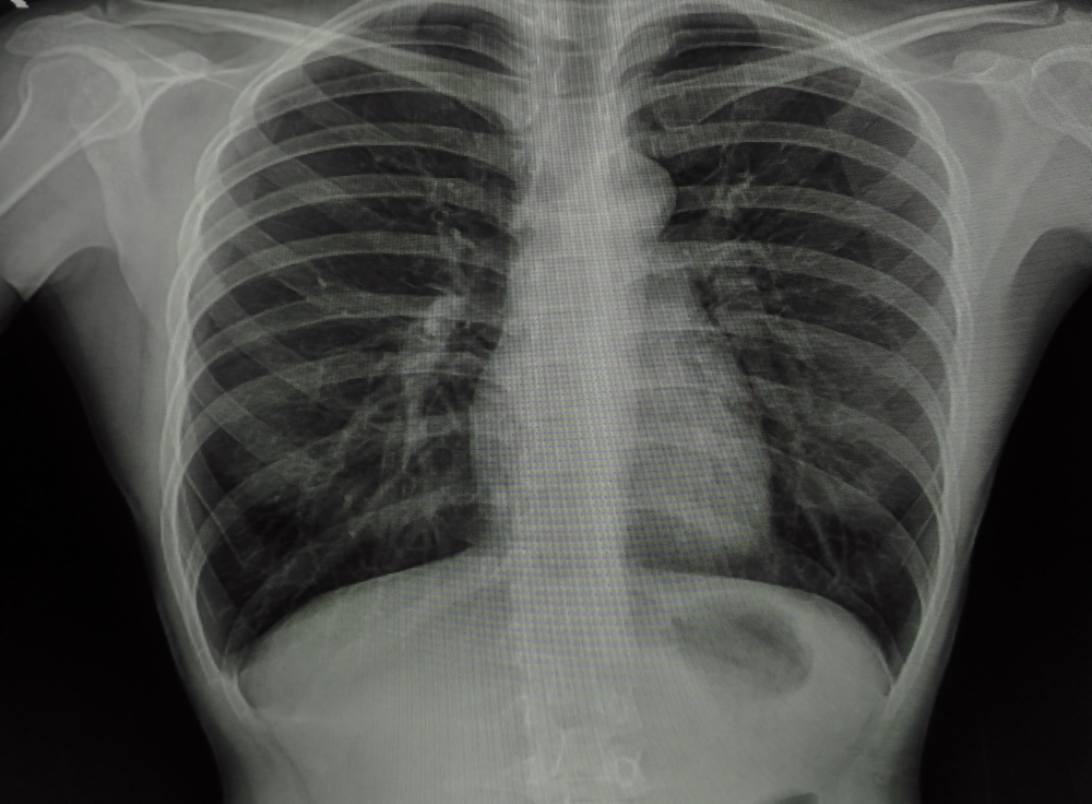 Derrame pleural (Empiema, Maligno)